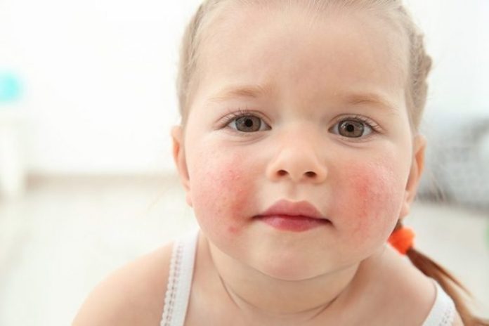 Food Allergies in Babies causes, symptoms and treatment - Loving Parents