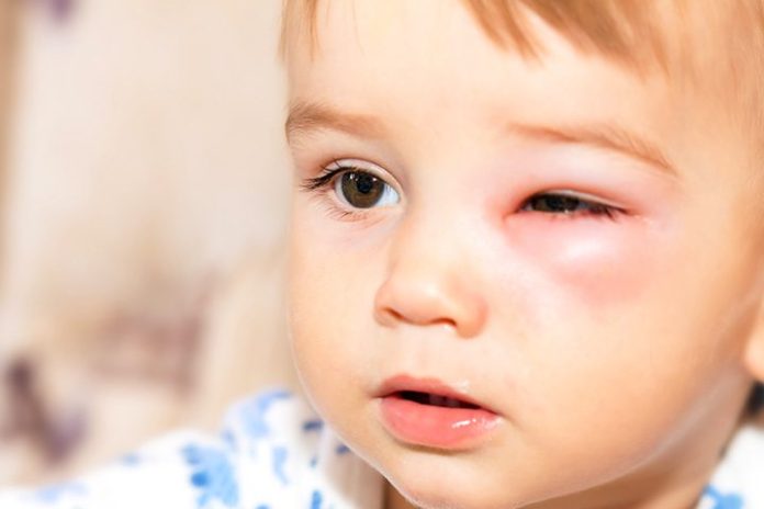 most-effective-tips-to-deal-with-5-most-common-eye-diseases-in-kids